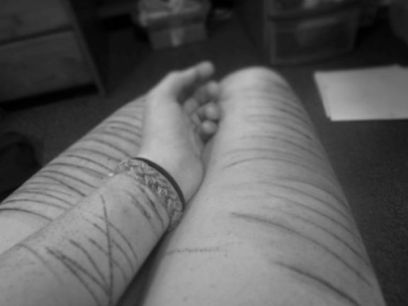 Autolesiones en adolescentes: ¿Cómo podemos ayudarles?